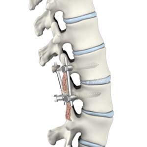 Posterior Lumbar Interbody Fusion