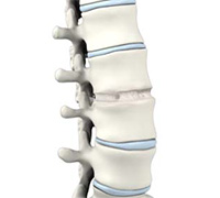 Anterior Lumbar Interbody Fusion