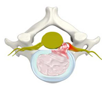 Cervical Disc Herniation