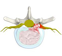 Lumbar Disc Herniation