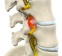 Lumbar Radiculopathy