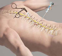 Minimally Invasive Spine Surgery