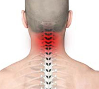 Chronic Neck Pain