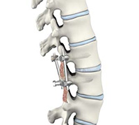 Posterior Lumbar Interbody Fusion