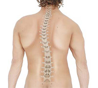 Scoliosis