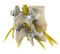 Spinal Fusion