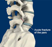 Spondylolysis