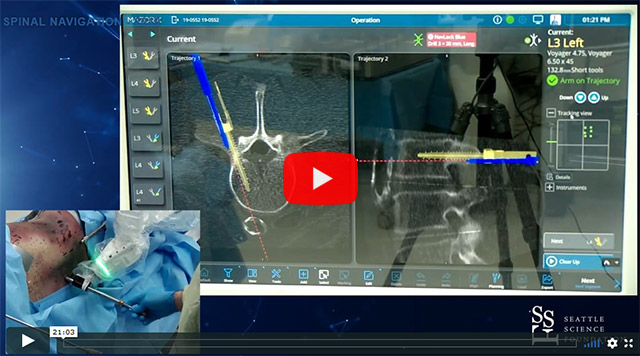 Robotic Simultaneous Lateral Posterior - Avery Buchholz, M.D., MPH